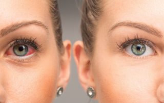 Glaucoma drops