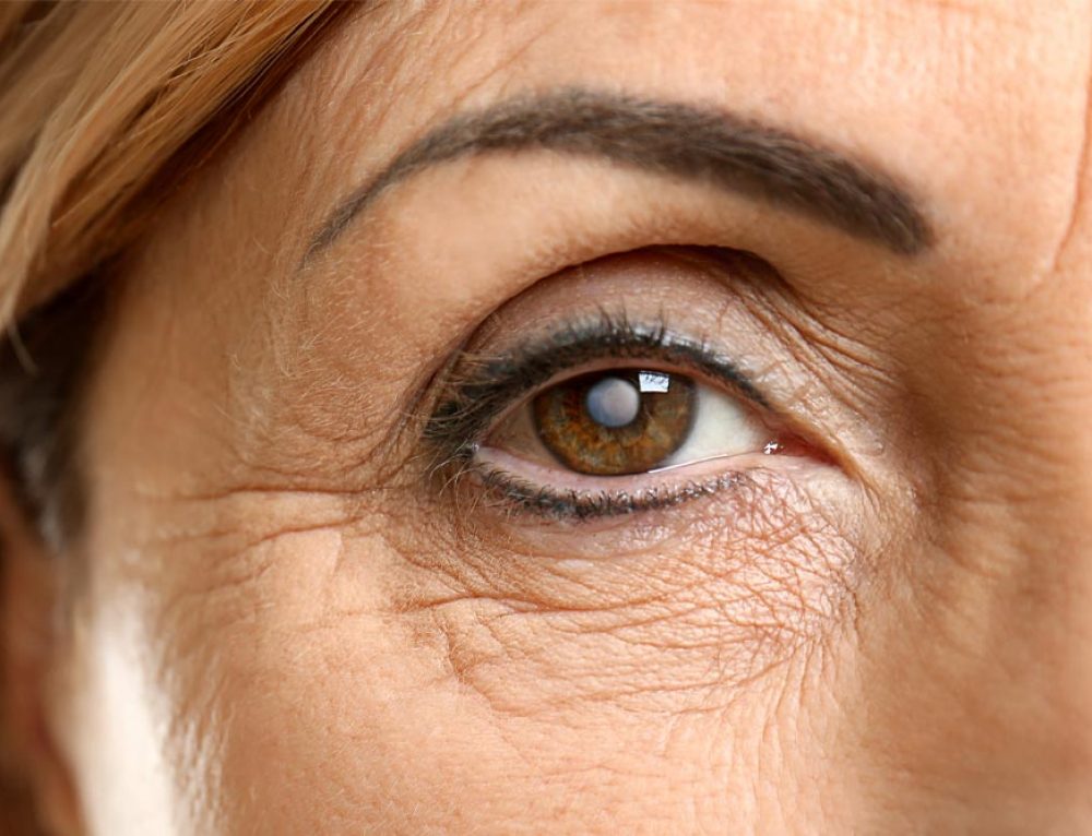 Blurred vision after cataract surgery? Laura Crawley London Eye Surgeon